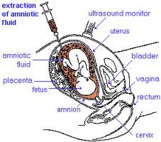 Gravidanza: l'esame amniocentesi